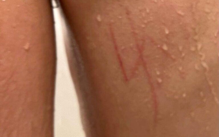 Swastika carved into US Jewish teen’s back at school; culprits not found in 6 weeks – The Times of Israel
